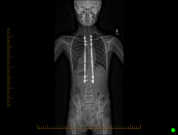 An x-ray shows a child's spine with growing rods attached.