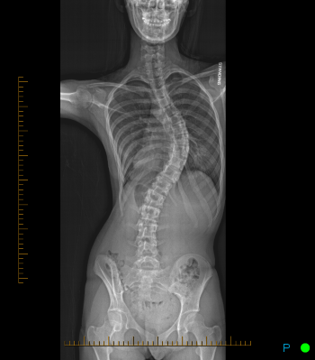 An x-ray showing a child's spinal curve from scoliosis