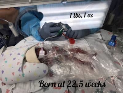 A very small newborn is in a neonatal intensive care unit bassinet. You can barely see his body underneath plastic sheeting. He is wearing a hat, and his head is cradled in a soft structure covered in fabric patterned with hearts. There is a tube taped to his face, covering up most of it. Behind him, hands in gloves are holding the tube. The hands are larger than the baby’s body. Copy on top of the picture reads “1 lbs, 1 oz” and “Born at 22.5 weeks”. 